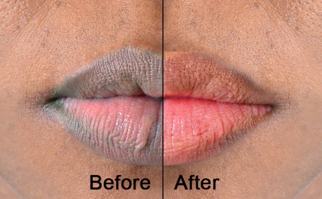 5 Natural Remedies for Pink Lips That Actually Work